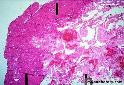 Nodules and Tumors of the liver