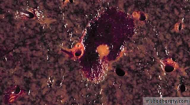 Nodules and Tumors of the liver