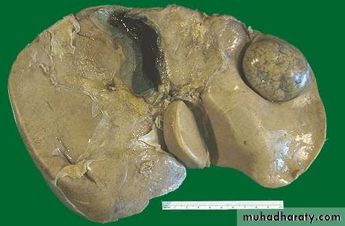 Nodules and Tumors of the liver