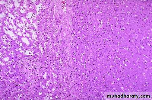Nodules and Tumors of the liver