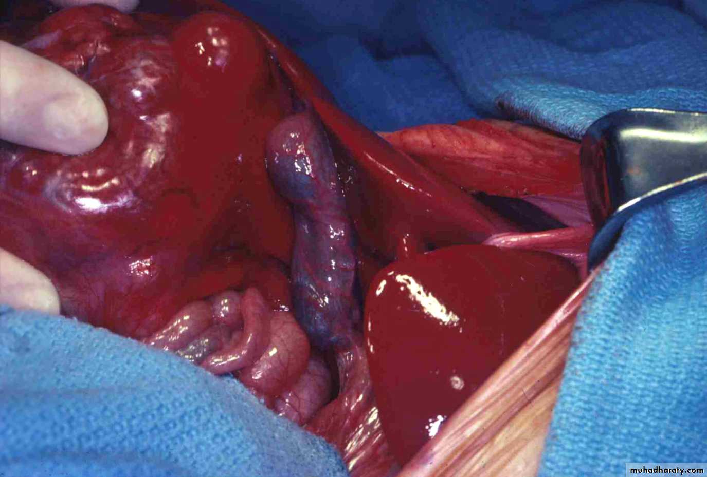 Nodules and Tumors of the liver