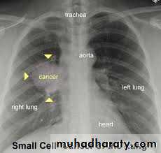 Tumours of the bronchus and lung