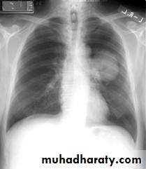 Tumours of the bronchus and lung