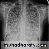 Tumours of the bronchus and lung