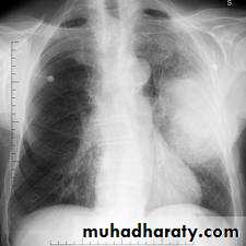 Tumours of the bronchus and lung