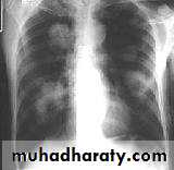 Tumours of the bronchus and lung