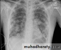 Tumours of the bronchus and lung
