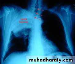 Tumours of the bronchus and lung