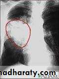 Tumours of the bronchus and lung