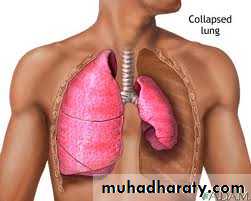 Pneumothorax