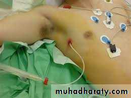Pneumothorax