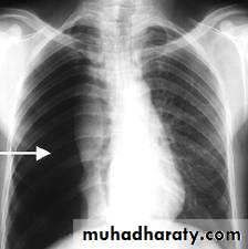 Pneumothorax