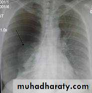 Pneumothorax