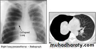 Pneumothorax