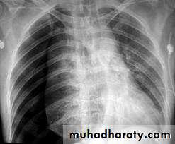 Pneumothorax