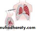 Pneumothorax