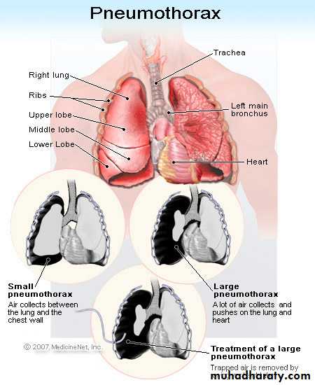 Pneumothorax