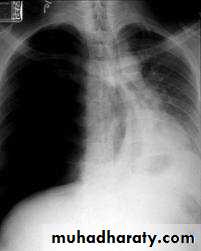 Pneumothorax