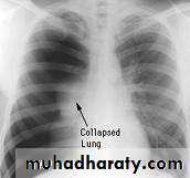 Pneumothorax