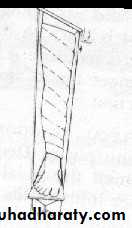 PRINCIPLE OF FRACTURES