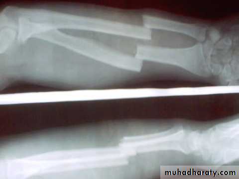 PRINCIPLE OF FRACTURES