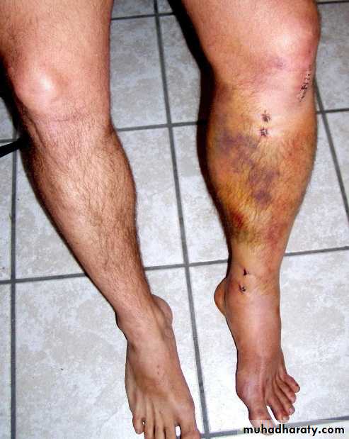 PRINCIPLE OF FRACTURES