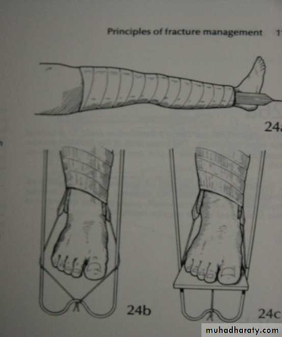PRINCIPLE OF FRACTURES