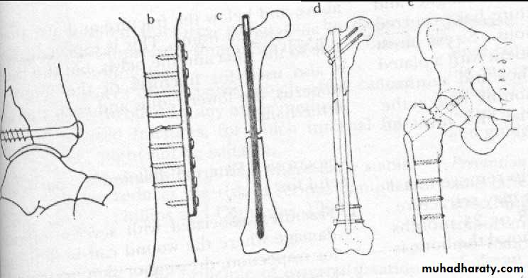 PRINCIPLE OF FRACTURES