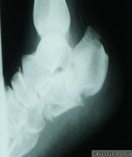 PRINCIPLE OF FRACTURES