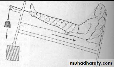 PRINCIPLE OF FRACTURES