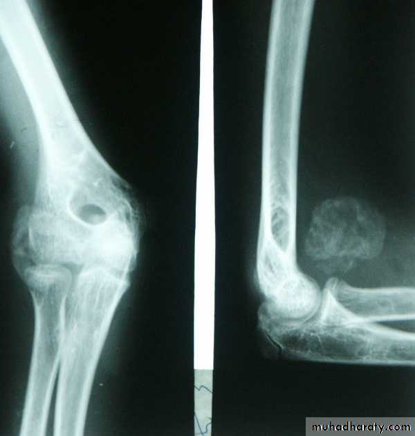PRINCIPLE OF FRACTURES