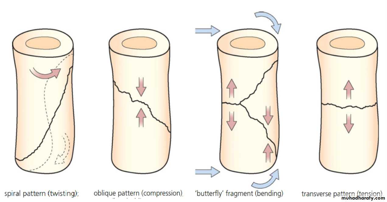 PRINCIPLE OF FRACTURES