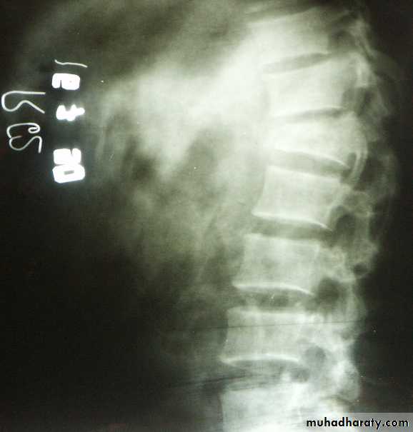 PRINCIPLE OF FRACTURES