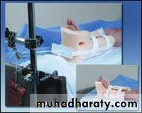 PRINCIPLE OF FRACTURES