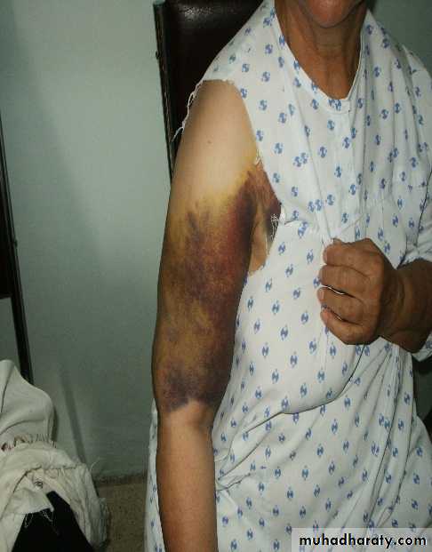 PRINCIPLE OF FRACTURES