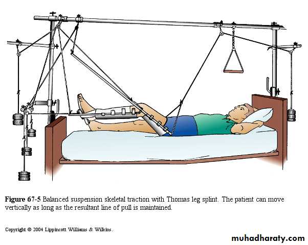 PRINCIPLE OF FRACTURES