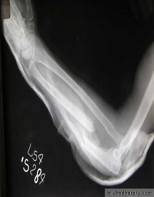 PRINCIPLE OF FRACTURES