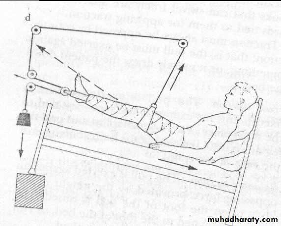 PRINCIPLE OF FRACTURES