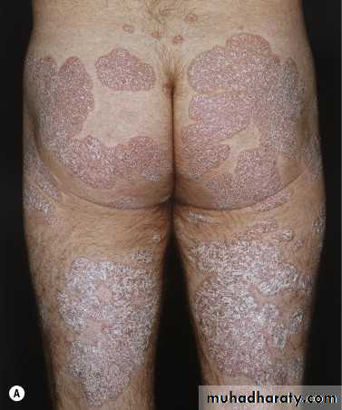 psoriasis