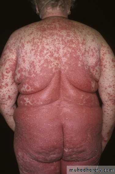 psoriasis