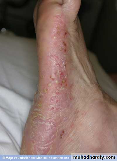 psoriasis