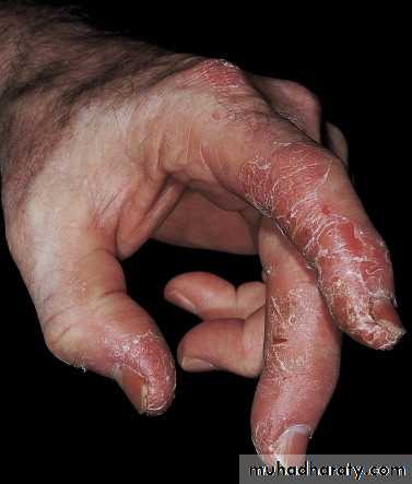 psoriasis