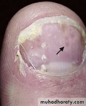 psoriasis