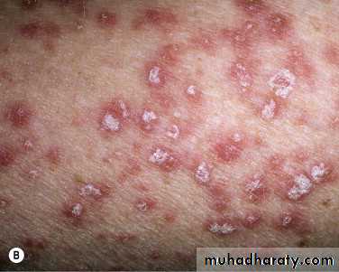 psoriasis