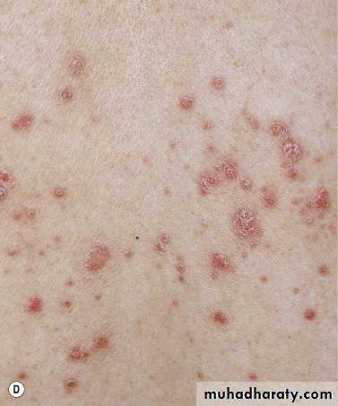 psoriasis