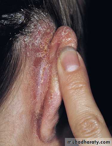 psoriasis