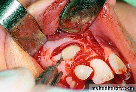 surgical aids in ortho