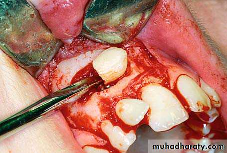 surgical aids in ortho
