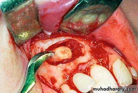 surgical aids in ortho