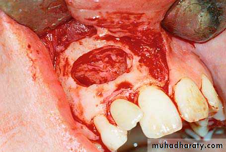 surgical aids in ortho